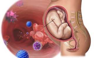 Streptococcus agalactiae в мазке из влагалища, уретры и цервикального канала – что делать, если выявлен