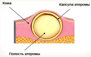 Шарик или шишка в мочке уха